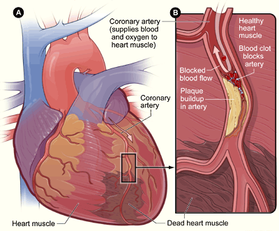 Chronic Heart Failure and disability
