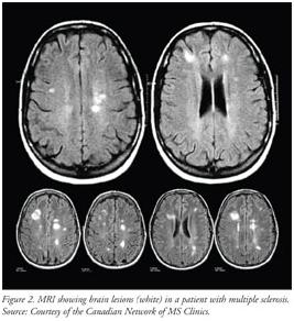 Can I receive disability benefits for my Multiple Sclerosis diagnosis?