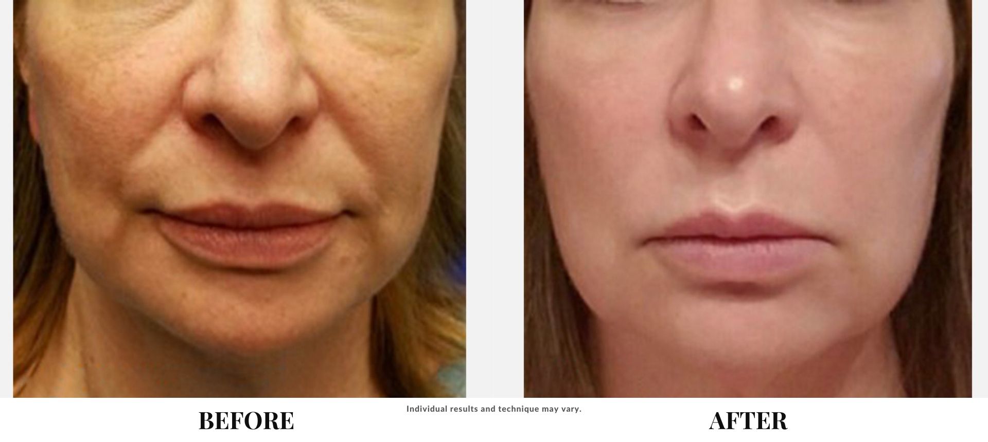 Silhouette_instaLift_treatment_before_and_after instaLift_before_and_after_treatment